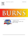 BURNS